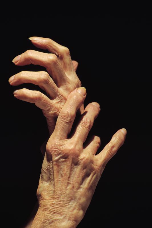 Rheumatoid arthritis